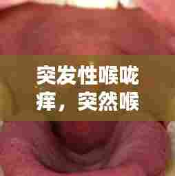 突发性喉咙痒，突然喉咙痒怎么缓解 