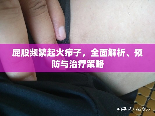 屁股频繁起火疖子,全面解析、预防与治疗策略